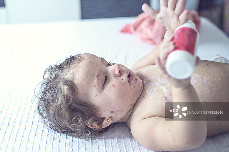 患有水痘，皮疹上涂有抗菌软膏的小女孩图片素材