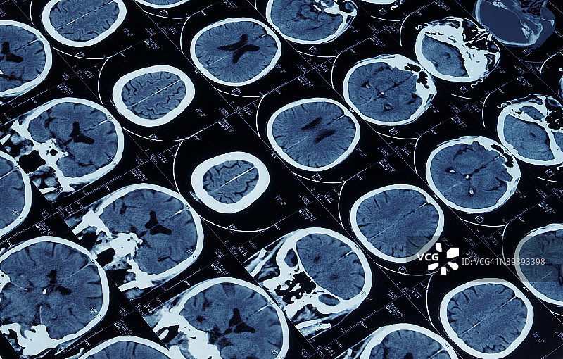 脑部磁共振成像图片素材