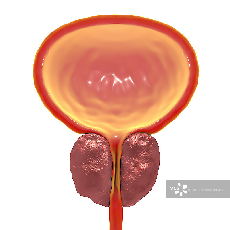 良性前列腺增生图片素材