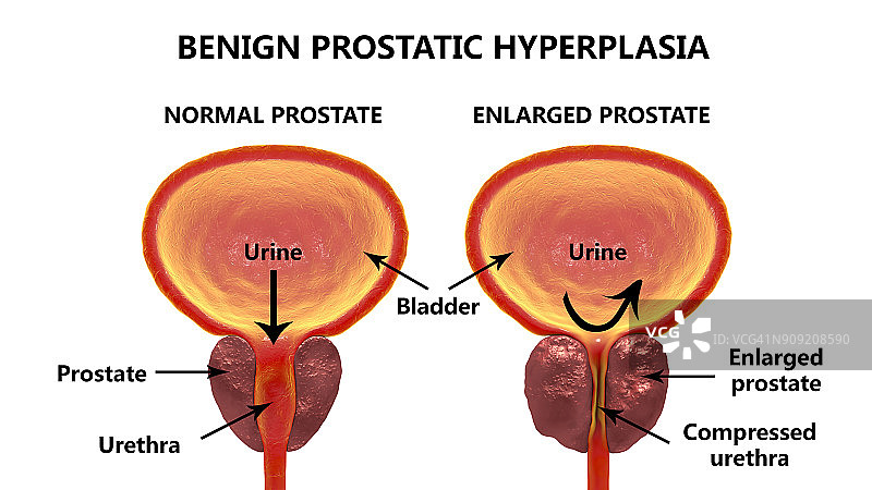 良性前列腺增生图片素材