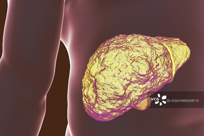 肝硬化插图图片素材