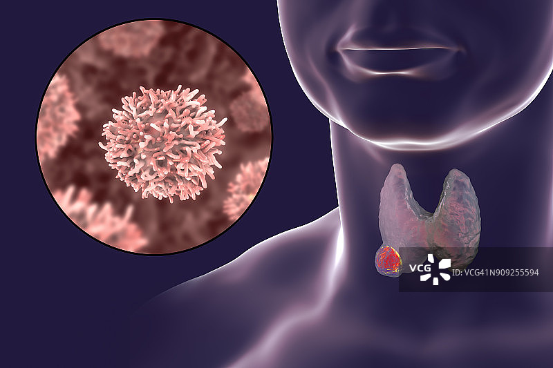 甲状腺癌插图图片素材