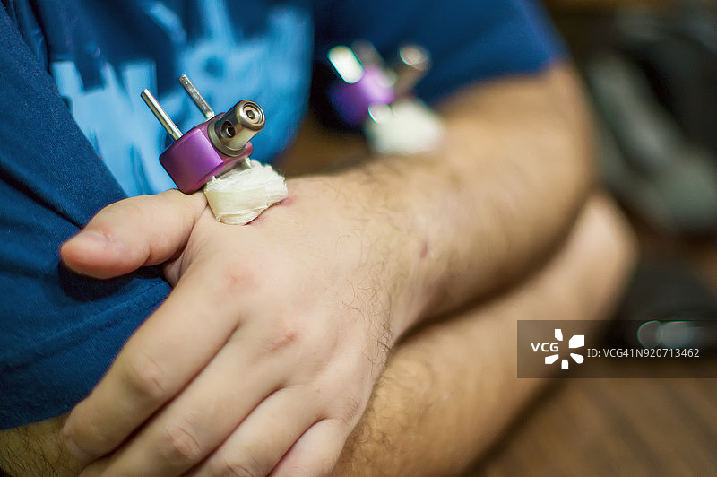 男子手腕和手臂骨折，使用钛制外固定器图片素材