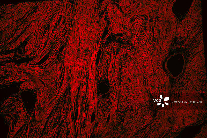 人类纤维瘤肿瘤的医疗荧光显微照片图片素材