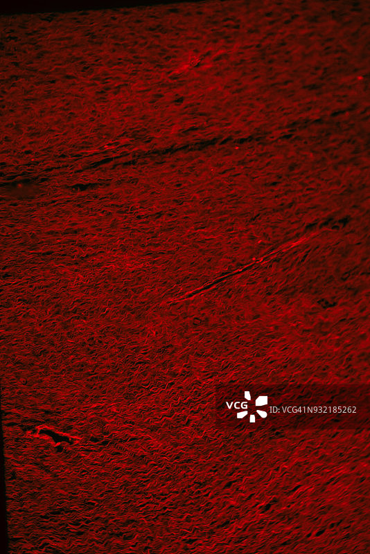 红色荧光显微照片：人纤维瘤图片素材