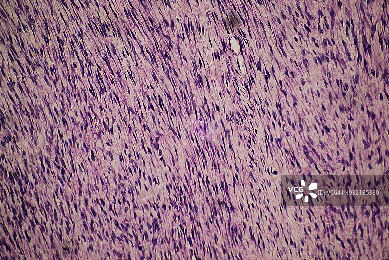 纤维瘤人体肿瘤图片素材