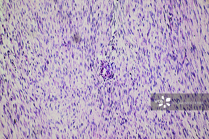 人体纤维瘤医学图图片素材
