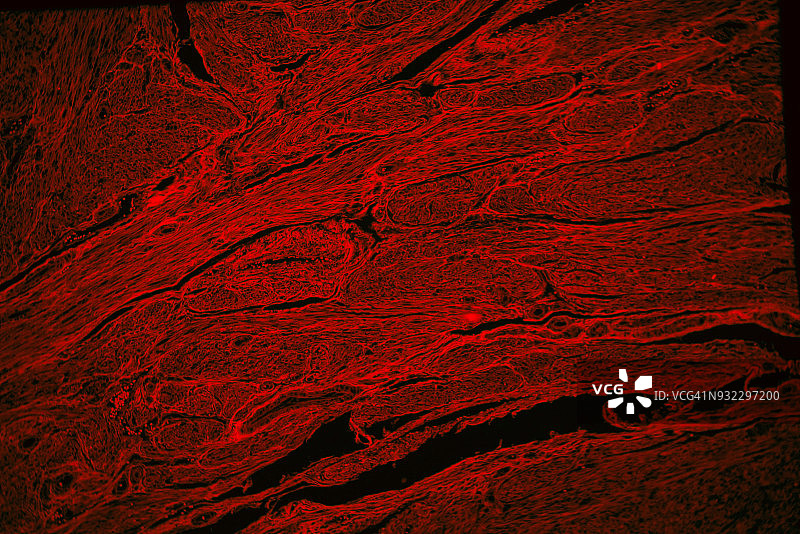 人子宫平滑肌瘤组织的红色荧光图片素材