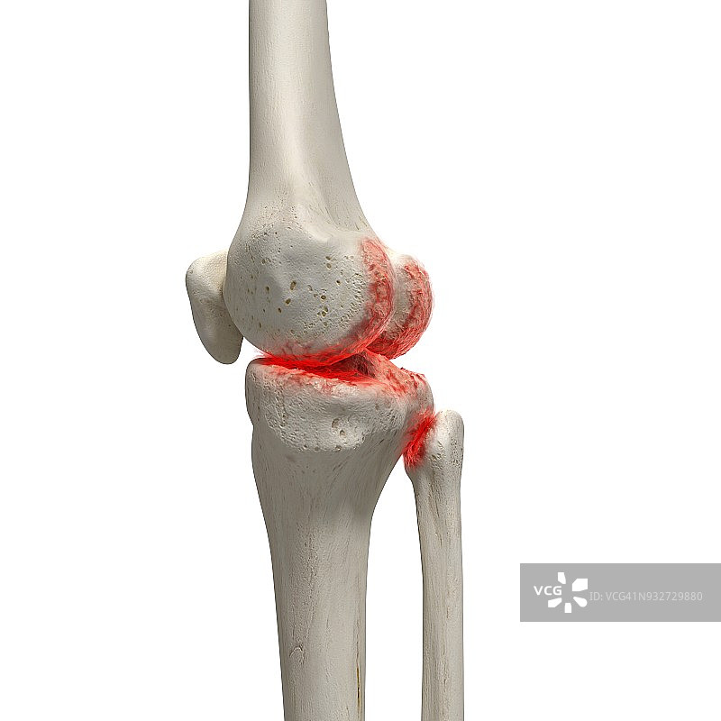 膝盖关节炎插画图片素材