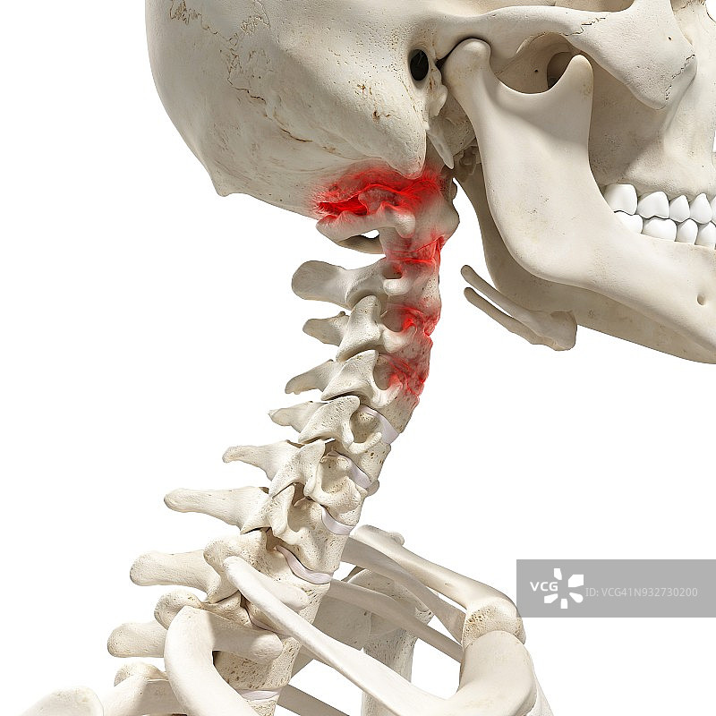 颈椎关节炎插图图片素材