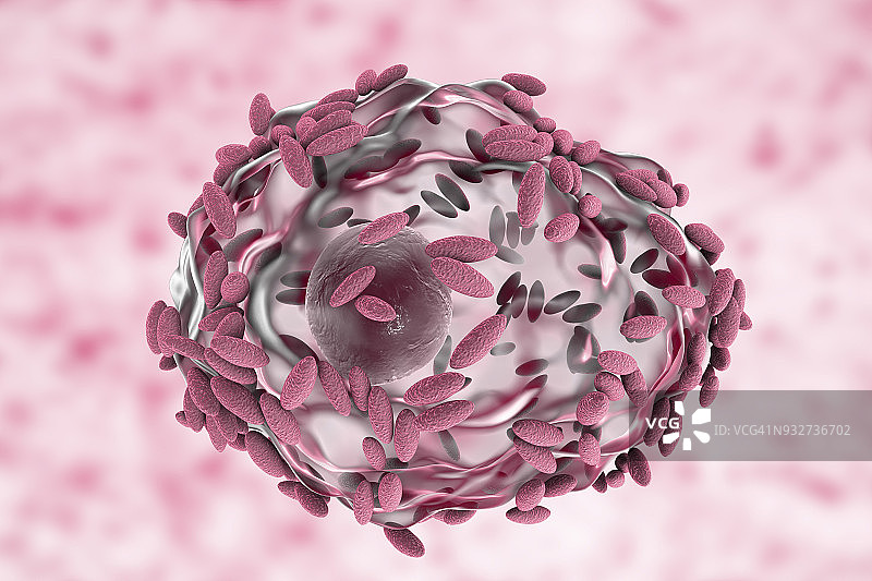 细菌性阴道病，图示图片素材