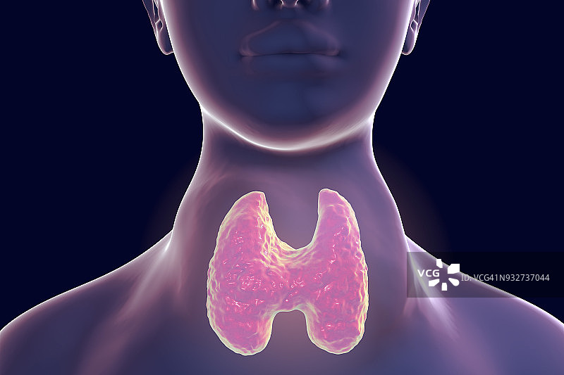 甲状腺肿插图图片素材