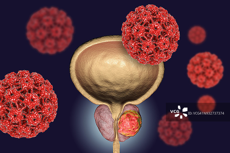 前列腺癌的病毒病因概念图图片素材
