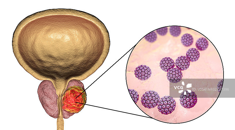 前列腺癌的病毒病因概念图图片素材
