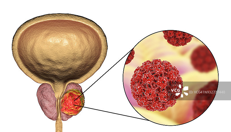 前列腺癌的病毒病因概念图图片素材