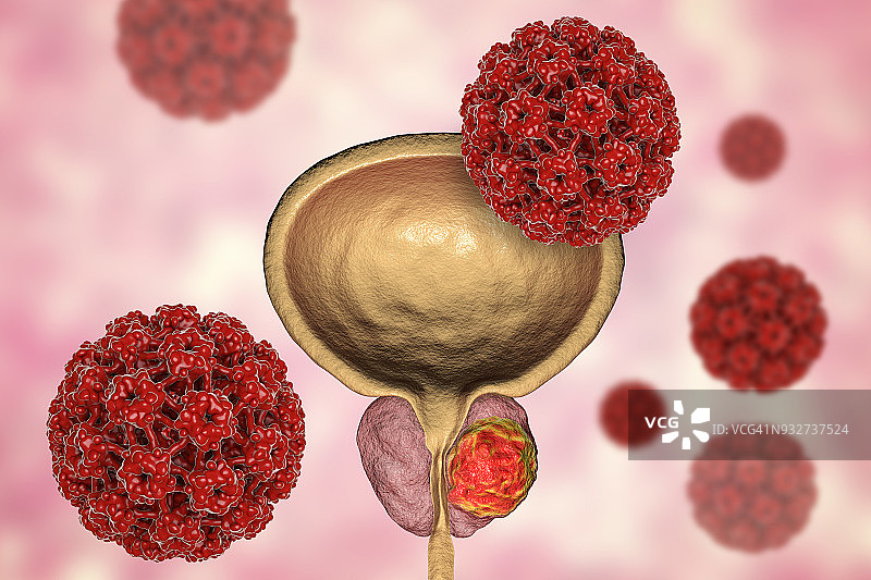 前列腺癌的病毒病因概念图图片素材