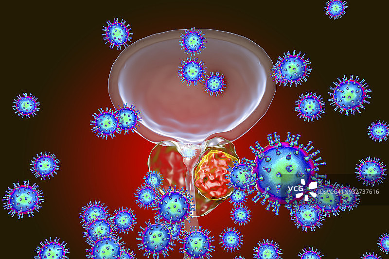 前列腺癌的病毒病因概念图图片素材