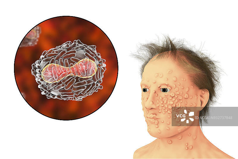 天花病毒和疾病插图图片素材