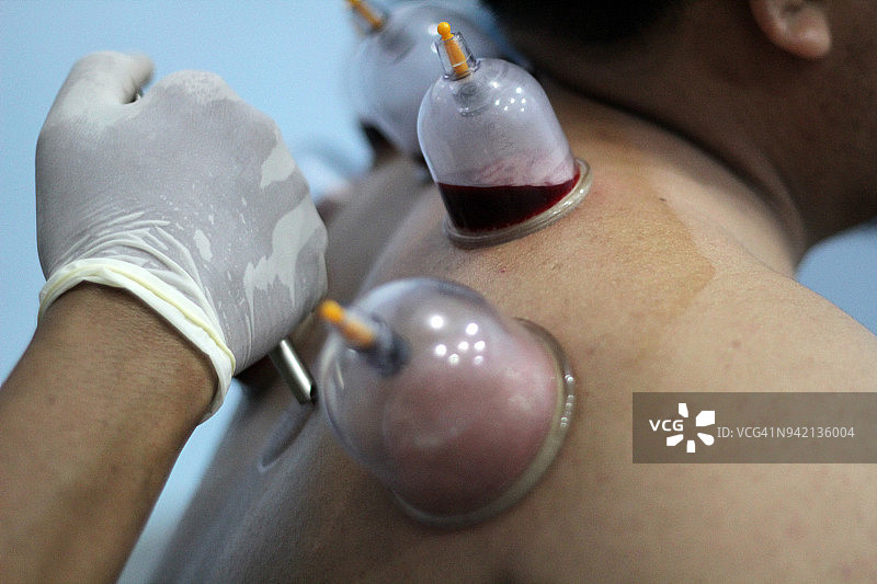 真空拔罐或湿法拔罐图片素材