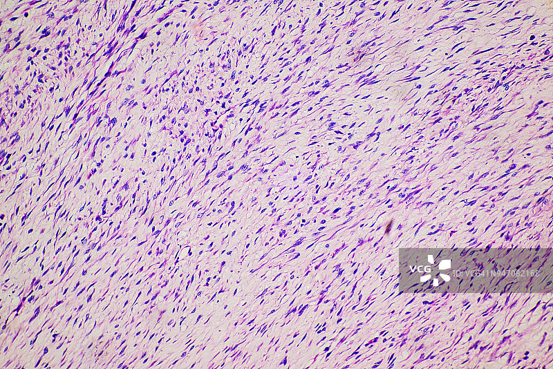 纤维瘤肿瘤细胞医学显微照片图片素材