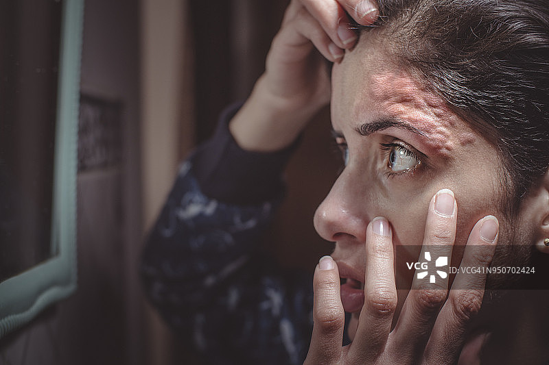 额头因穿线引起的皮肤炎症图片素材