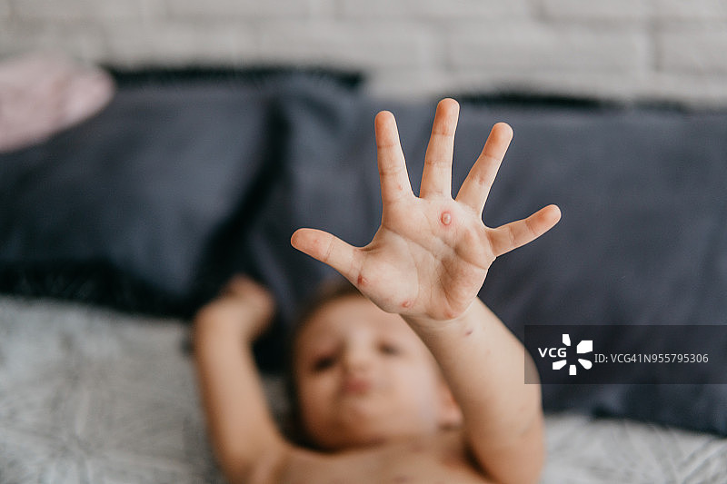 得了水痘的小女孩图片素材