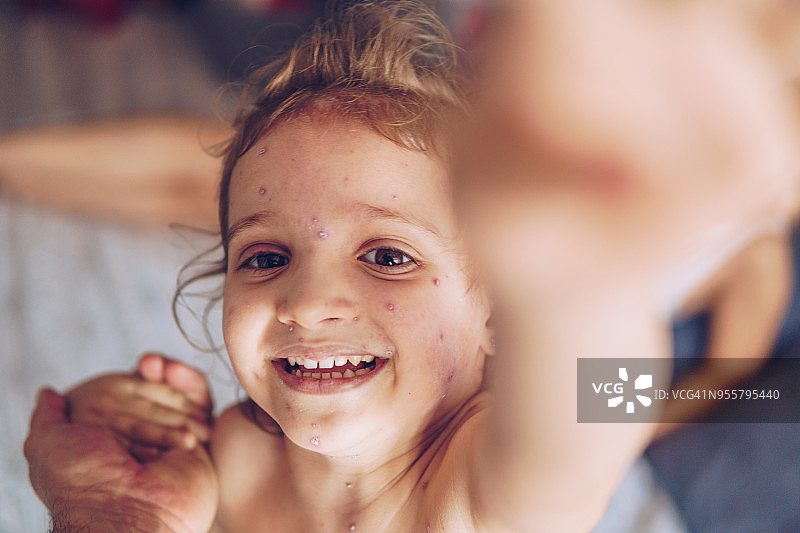 得了水痘的小女孩图片素材