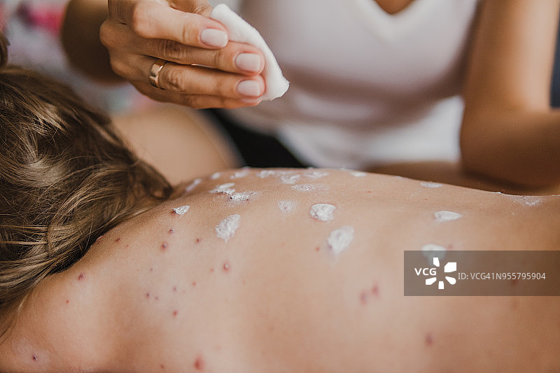 母亲照顾患有水痘的小女孩图片素材