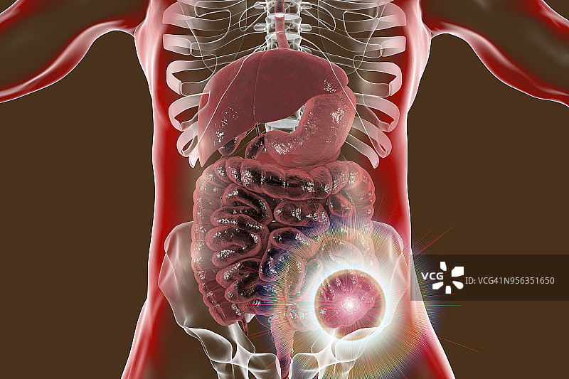 结肠癌治疗概念图图片素材