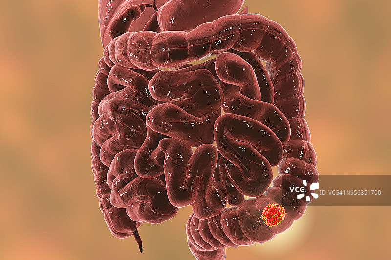 结肠癌，图示图片素材