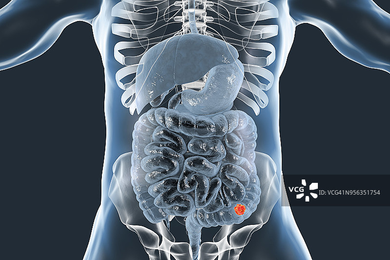 结肠癌，图示图片素材