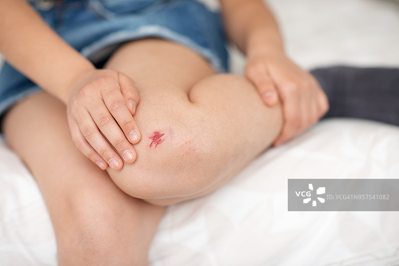 特写：膝盖擦伤的年轻女孩图片素材