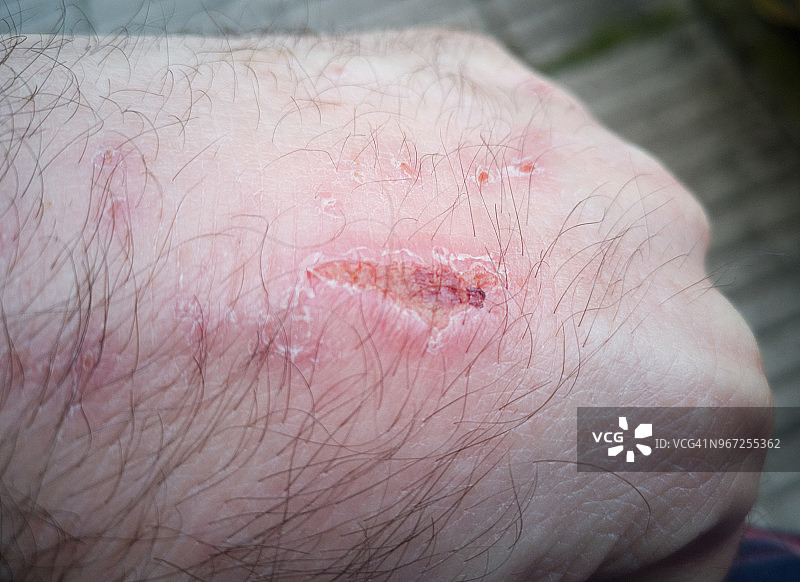 手上的伤口图片素材