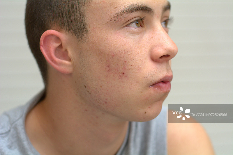 长粉刺的青少年吃早餐图片素材