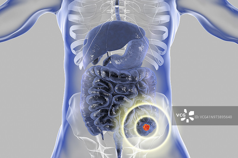 结肠癌治疗概念图图片素材