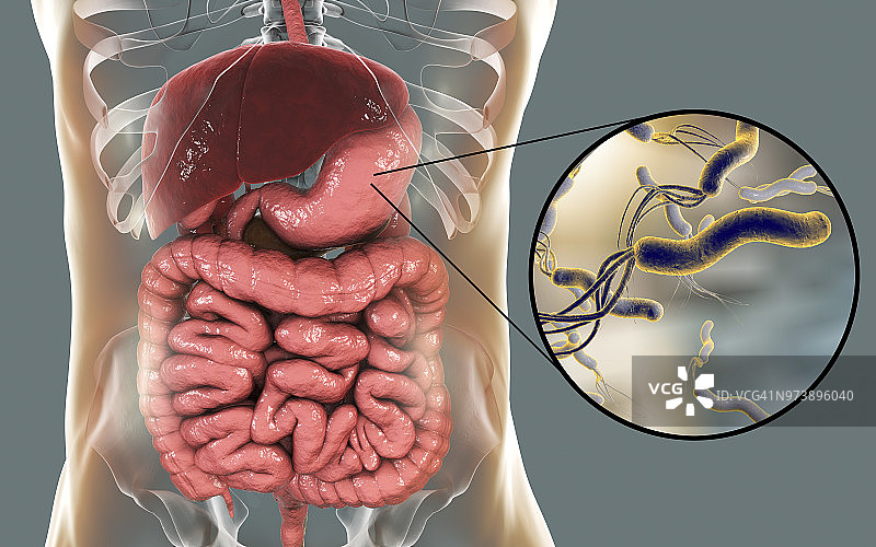 幽门螺杆菌示意图图片素材