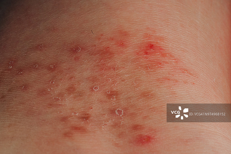 患病人皮炎湿疹纹理图片素材