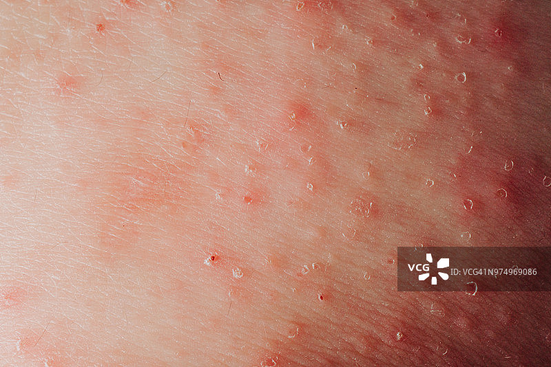 患病人皮炎湿疹纹理图片素材