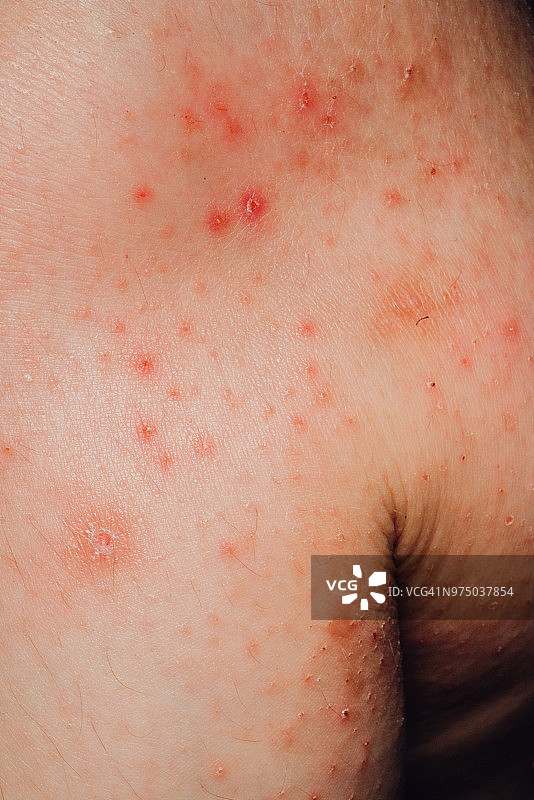 湿疹过敏皮肤图片素材