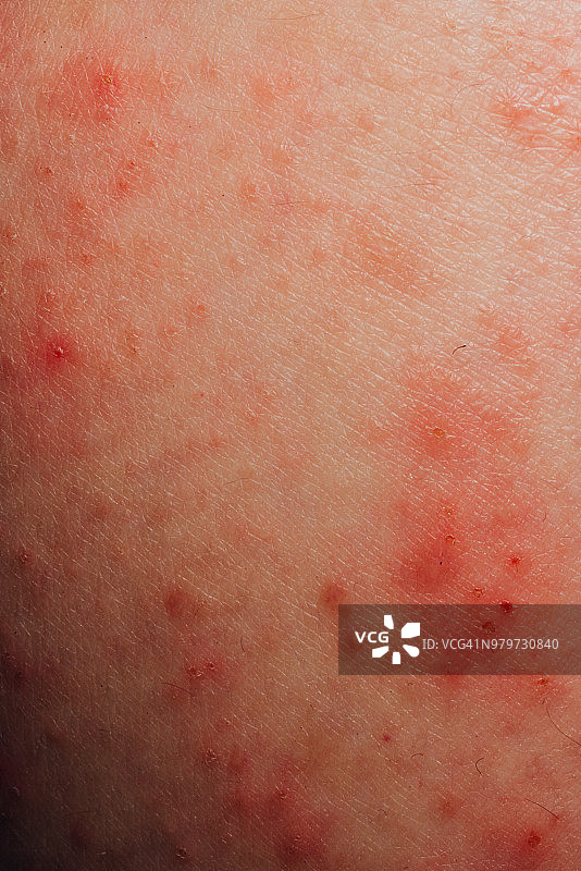 患病皮肤湿疹图片素材