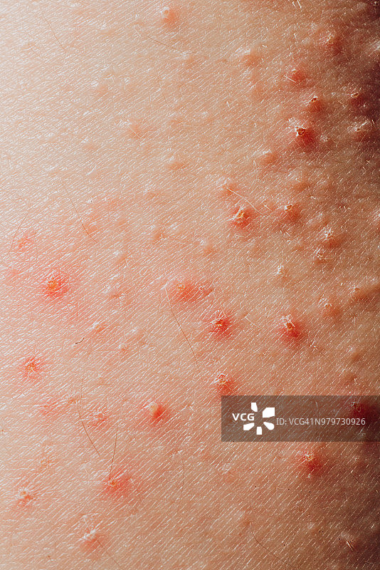 患病皮肤湿疹图片素材
