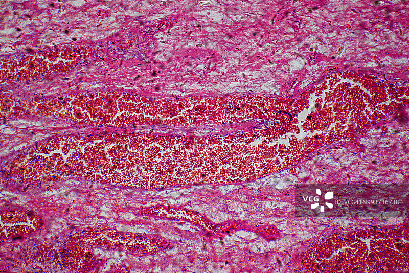 医疗血管瘤肿瘤图片素材