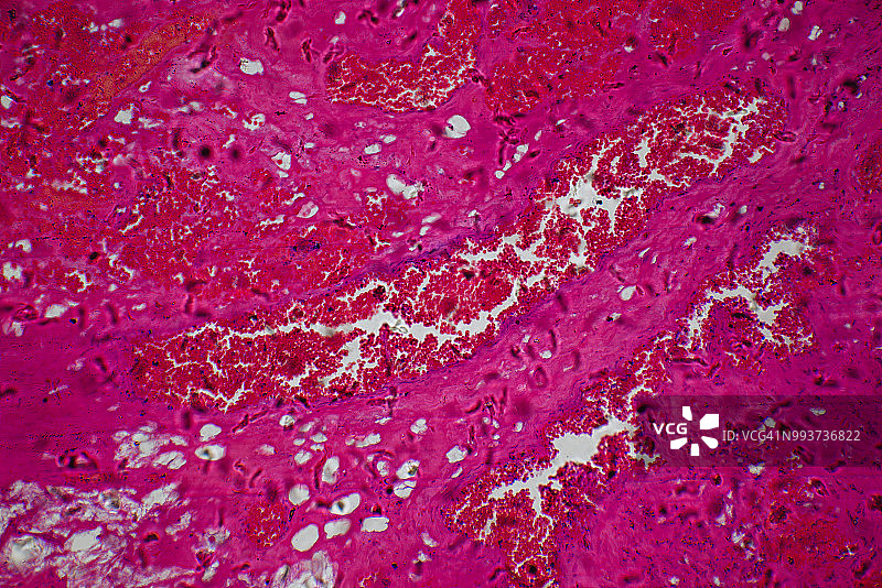 医疗血管瘤肿瘤图片素材