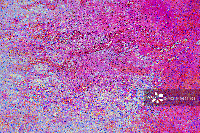 医疗血管瘤肿瘤图片素材
