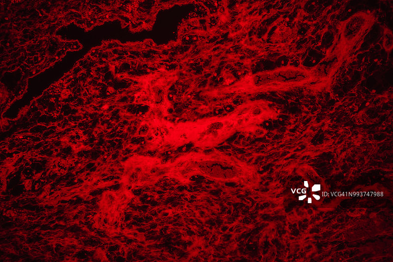 医疗血管瘤肿瘤图片素材