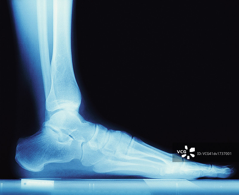 人的脚X光片图片素材