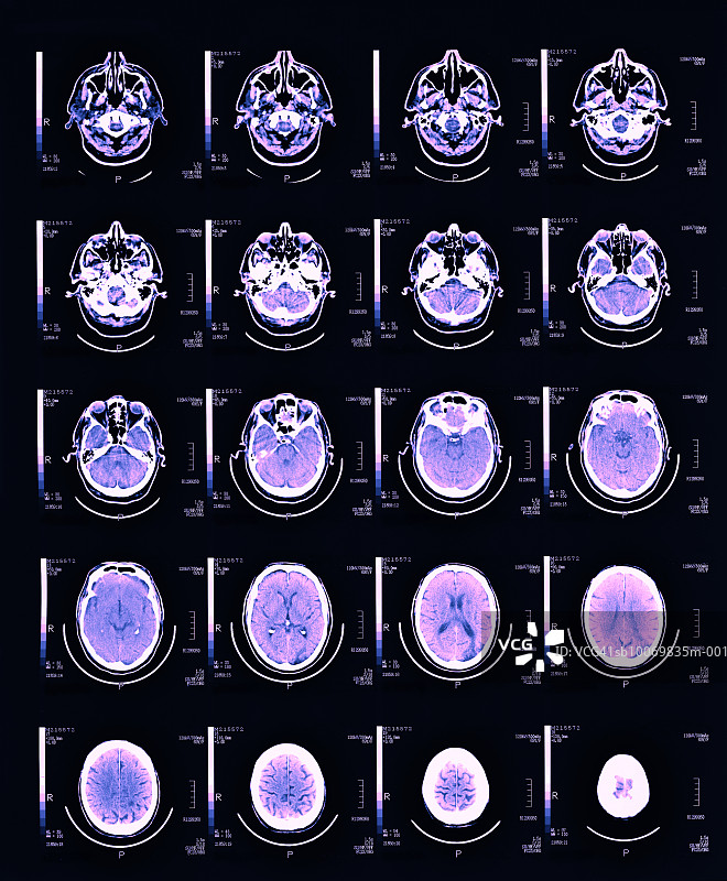 核磁共振脑部扫描特写图片素材